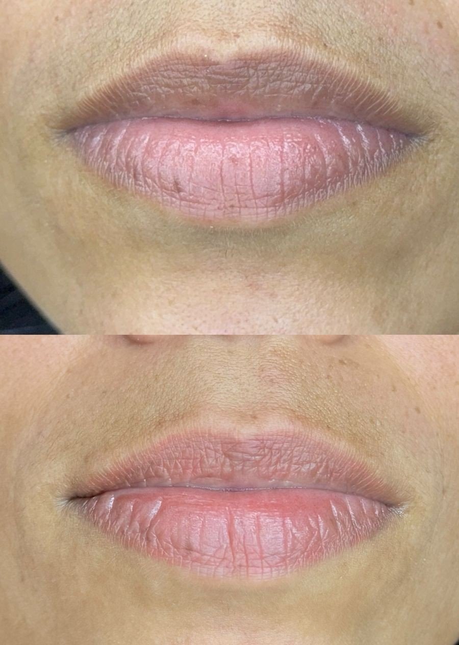 Neutralização labial
