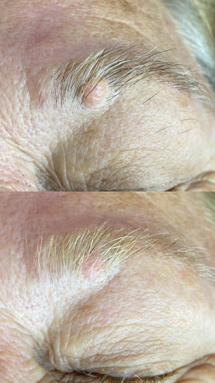Remoção de sinais estéticos (pintas e verrugas)